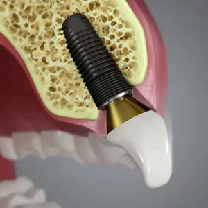 6 Tips to Pick Dentist to Affix Dental Implants