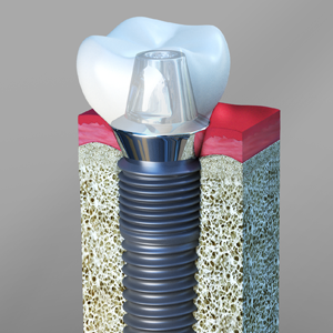 Implant Dentist Ramsey NJ
